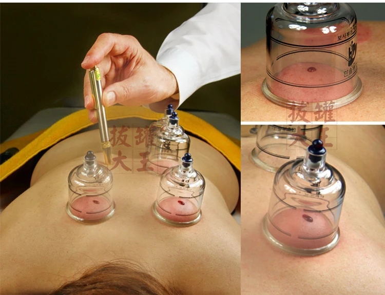 Высокое качество High-end бытовые вакуумные банки бак стульчиков 19 банок vent крови