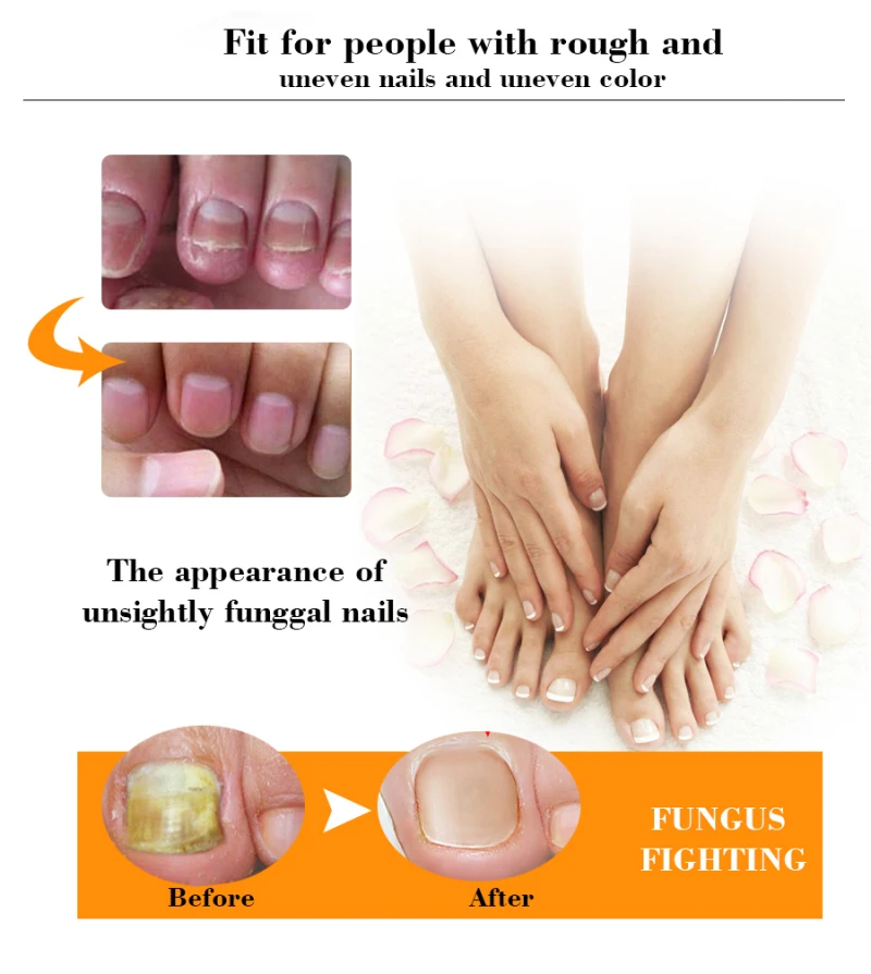 Эссенция для лечения Ногтей от грибков и онихомикоза 20 г|Средства ухода за