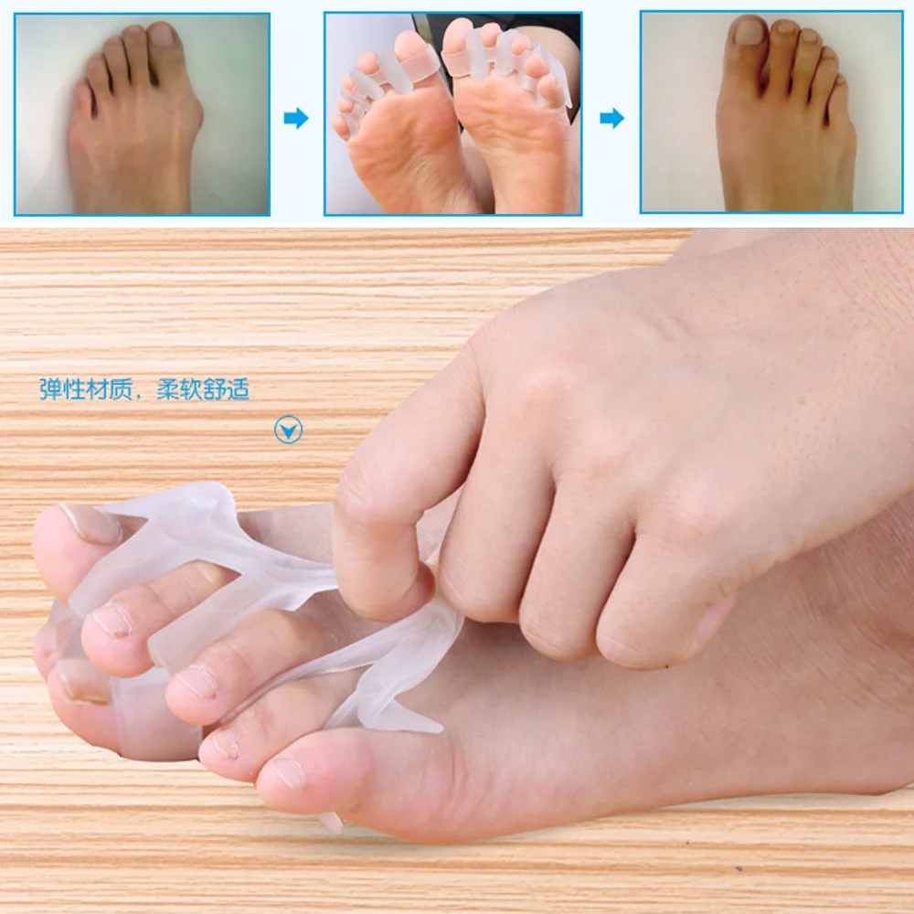 1 пара новые оригинальные ортопедические Брекеты для вальгусной деформации