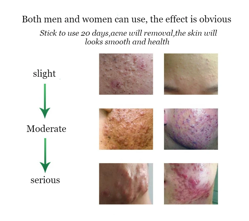 Dimollaure женьшень акне очищающий травяной крем уход за кожей удаление Комедон