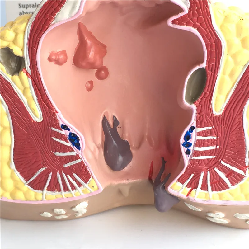 Anatomical model of appendix and cecum Medical teaching Human anorectal pathological | Канцтовары для офиса и дома