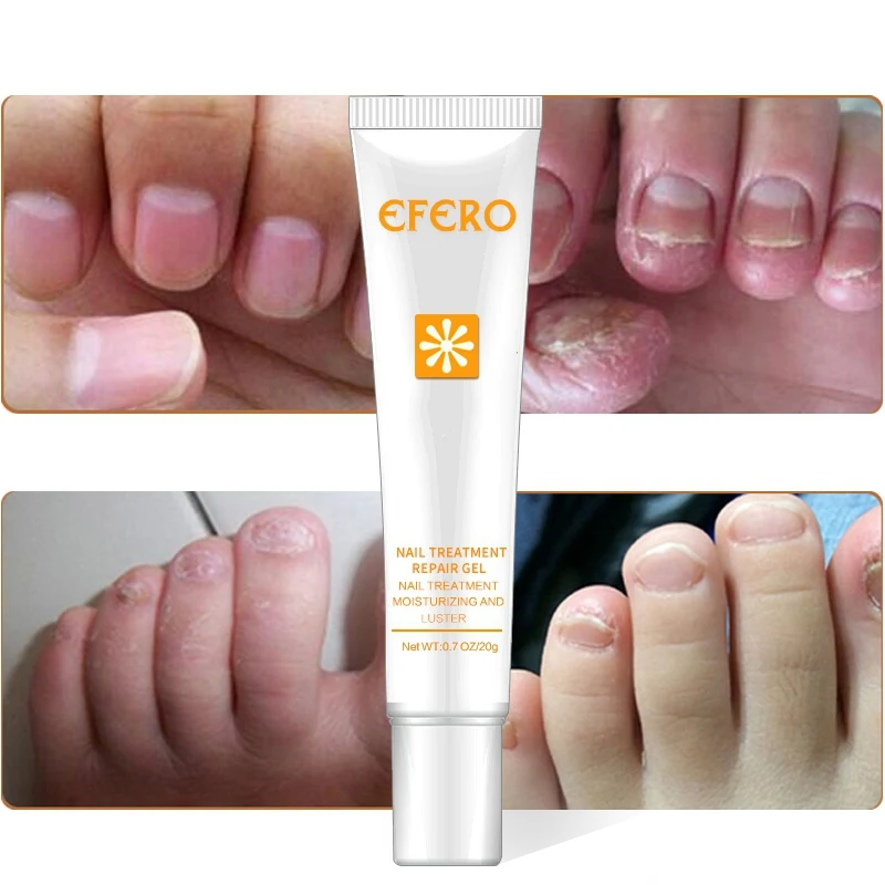 Nail Treatment Repair Gel Growth Product Remove Onychomycosis Broken Treatments | Красота и здоровье