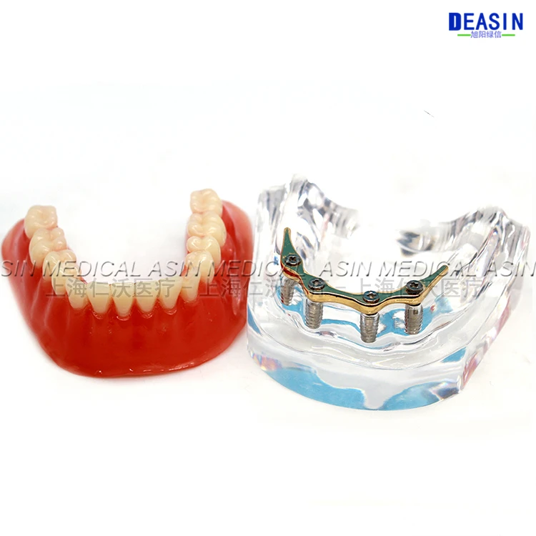 1 pc x high quality Resin Coverage dental implant model dentures Removable teeth for dentist study Deasin |
