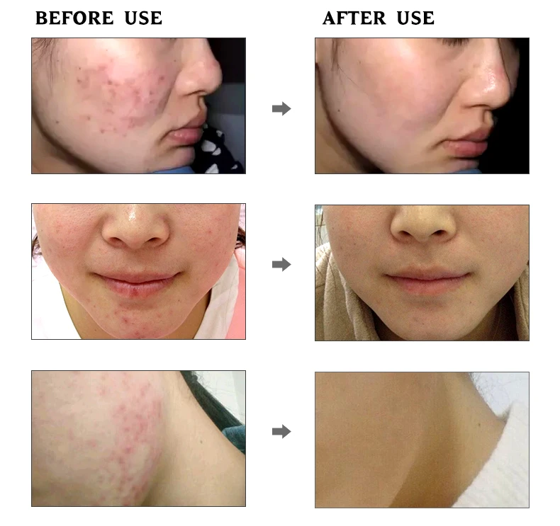 Увлажняющая эссенция ROREC Green tea seed, эссенция для лица, увлажнение, Элитная жидкость, мягкий и глубокий питательный гель для кожи