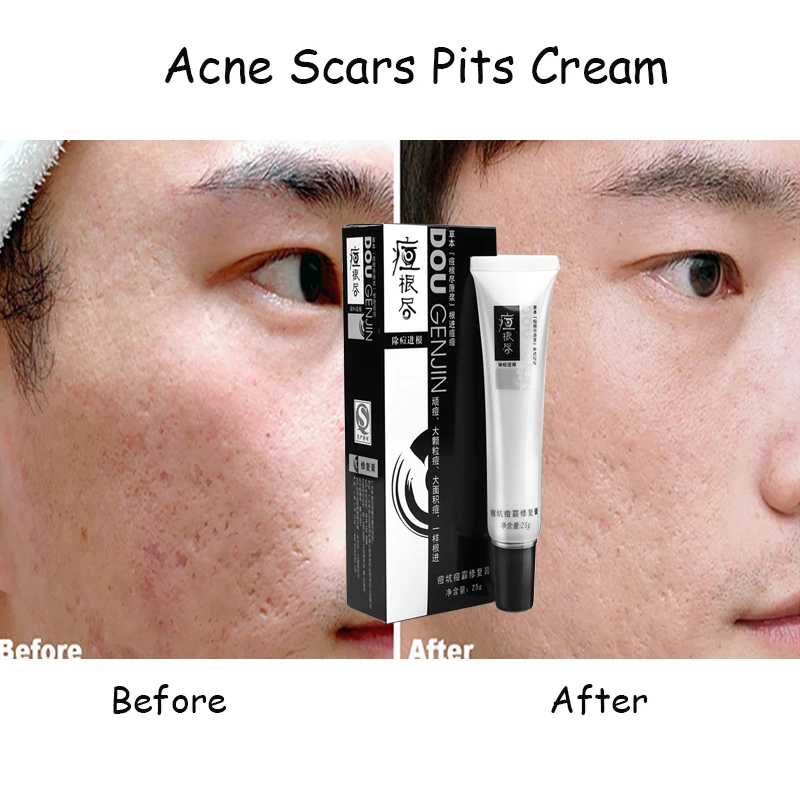 Крем против акне и шрамов сыворотка акне|serum anti acne|serum creamserum acne |