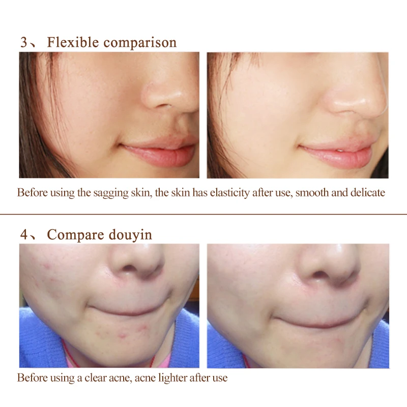 Baimiss улитка сыворотки ремонт лосьон для лица крем лечение акне угорь уход за