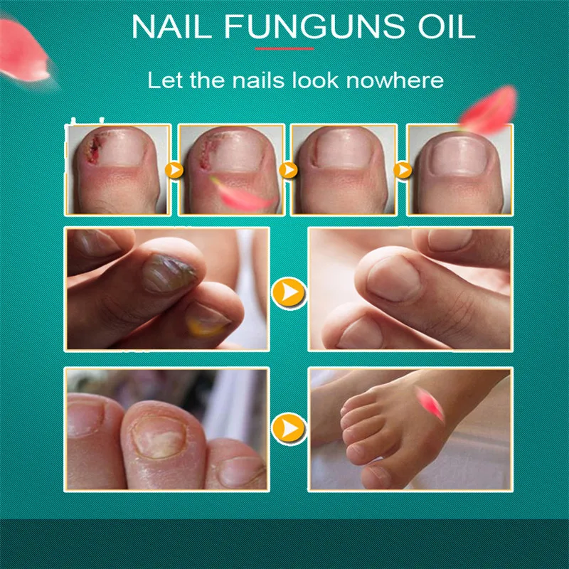 Увлажняющая Жидкость для ногтей Лечение грибка удаление грибковой инфекции уход