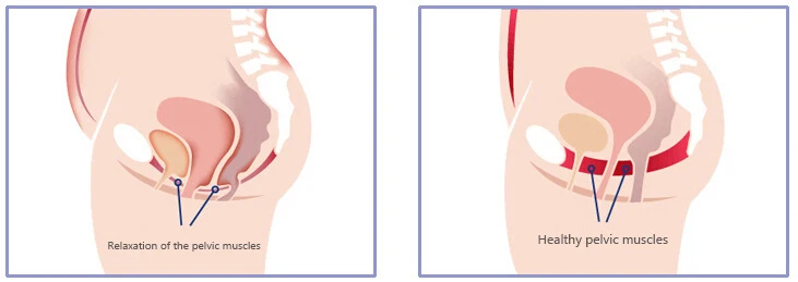 Kegel упражнения вагинальный массаж мышцы тазового дна женский недержание терапия вагинальный стимулятор тренажер тазового дна