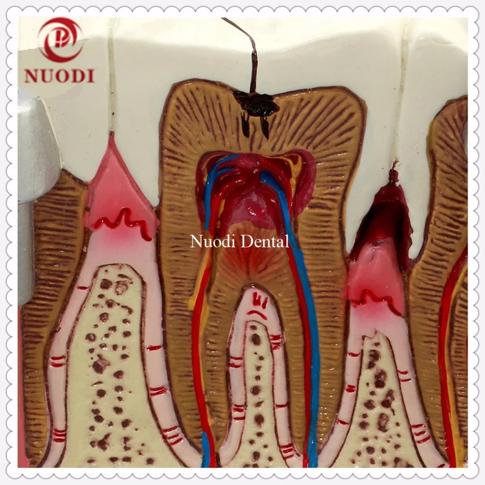 Dental Implant Teeth Model/Dentistry Disassembling Caries dental tooth Model/4times teeth model |