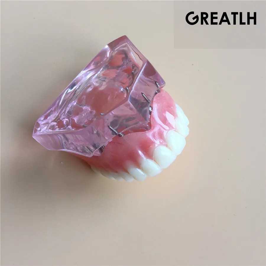 Модель зубного имплантата зубные зубы модель|dental tooth|teeth modeltooth teeth |