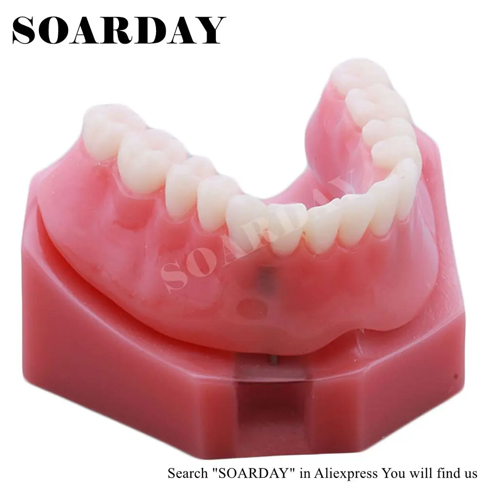 SOARDAY Overdenture нижняя с 2 имплантатами стоматологический зуб стоматолог
