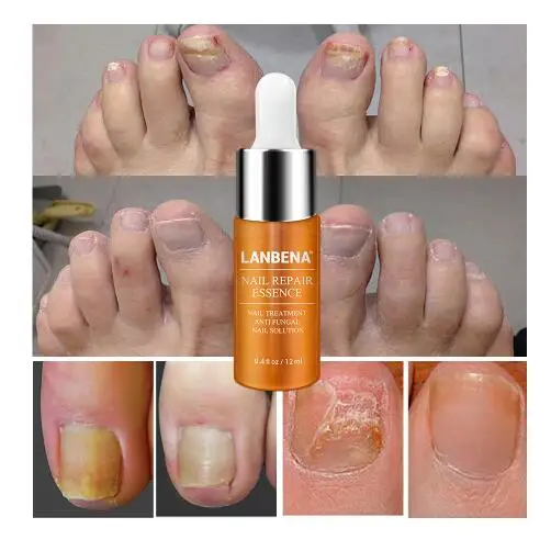 LANBENA nail repair essence serum Nail treatment of the fungus remove Onychomycosis feet nourishing brightening hand and foot ca |