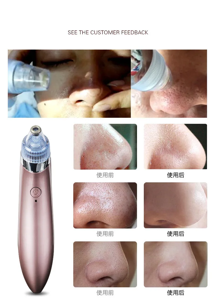 Pro вакуумный отсос для угрей пор пылесос электрическое очищение от акне