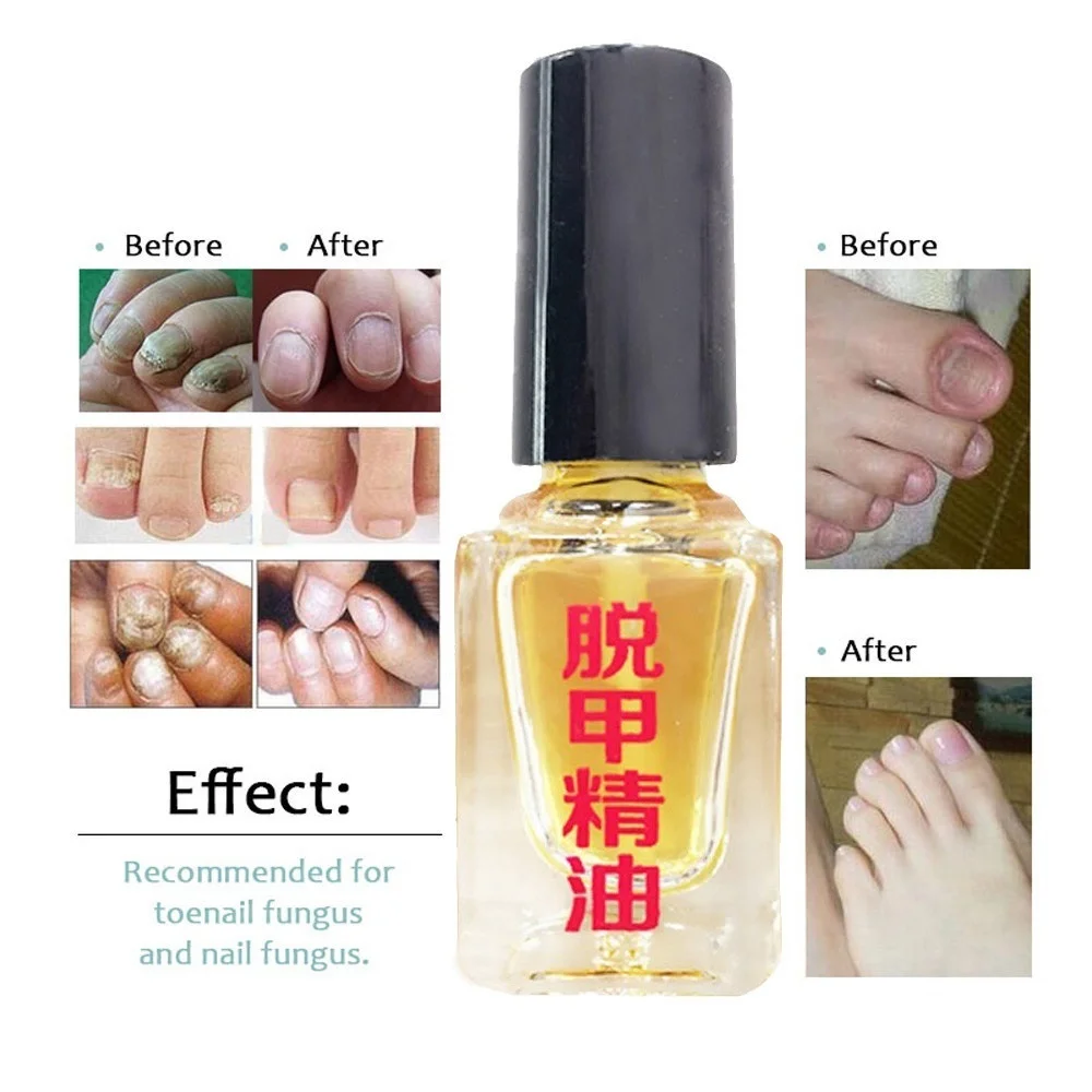

Really work Nail Treatment Removal of onychomycosis Paronychia Anti oil Fungal Nail Infection Toe Nail Fungus Treatment oil