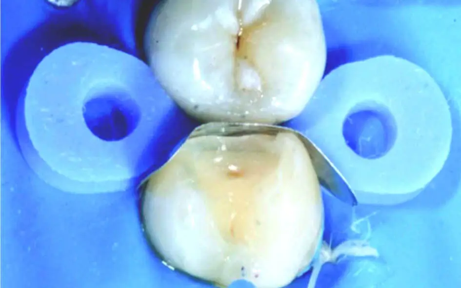 40 шт./компл. стоматологические эластичные фиксирующие матрицы на танкетке