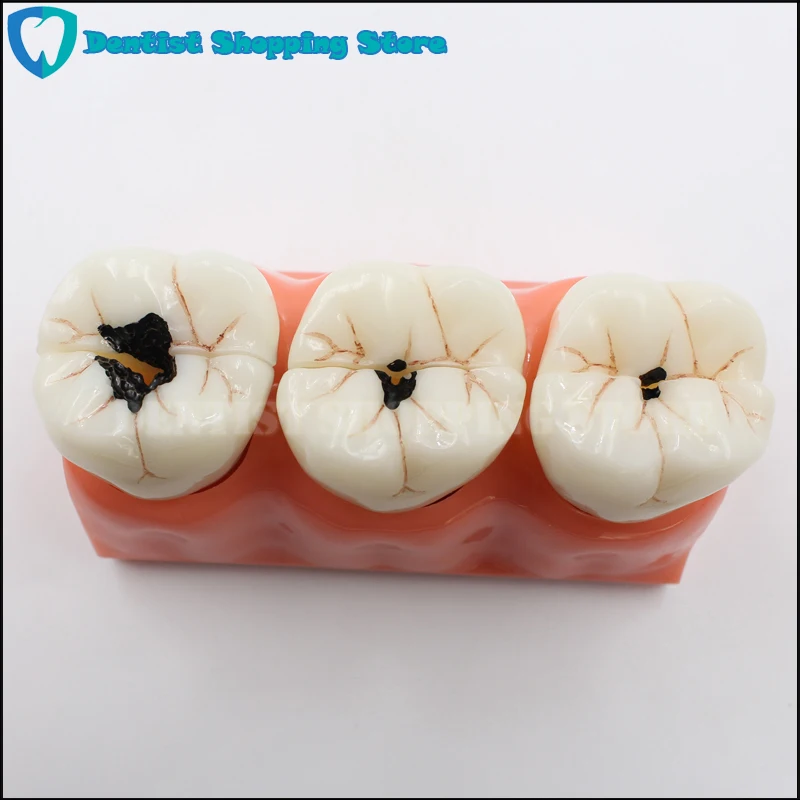 

4X Enlarge Teacher Student Oral Care New Dental Teeth Model 4 Times Teeth Mode Patient Education Model Caries Treatment Model
