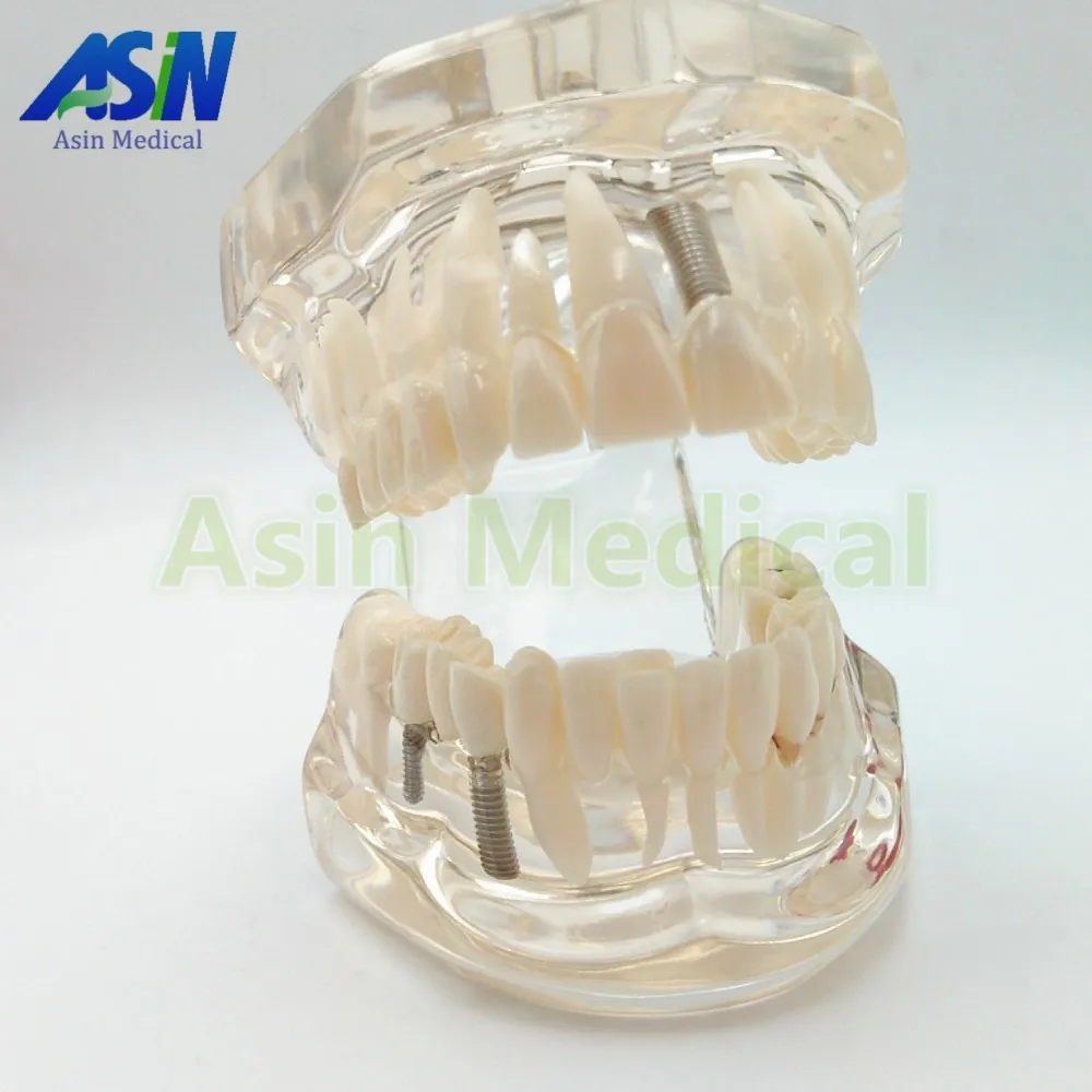 Демонстрационный кронштейн для имплантации зубов модель съемный | Красота и