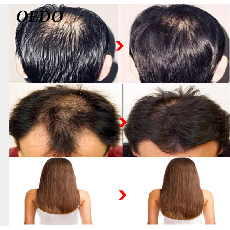 Уход за волосами эссенция лечение травяной женьшень для выпадения волос быстрая