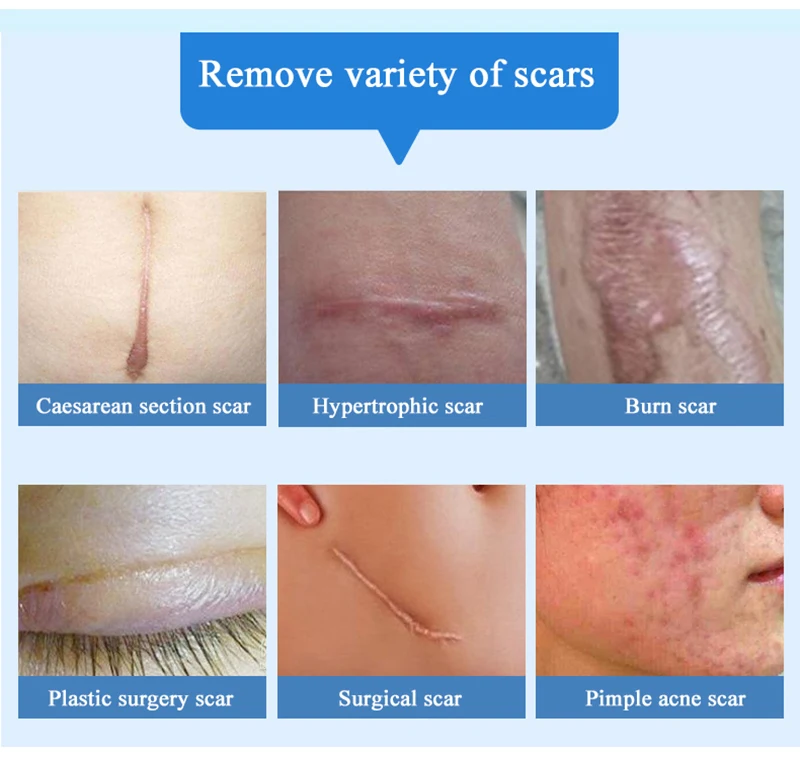 Youhekang мазь от рубцов мазь от шрамов пластырь от шрамов пластырь от рубцов scar plaster лечебные мази face plasters