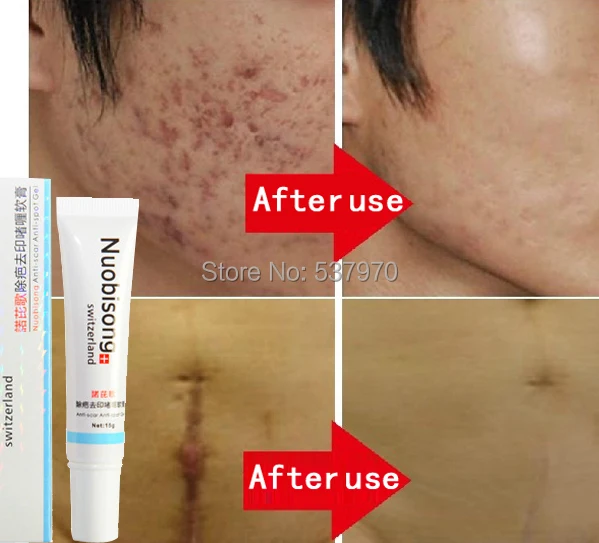 Nuobisong 15ml Facial Treatment Cream To Treat Acne Scars Scald Striae Of Pregnancy Face Care Stretch Marks Free Shipping | Красота и