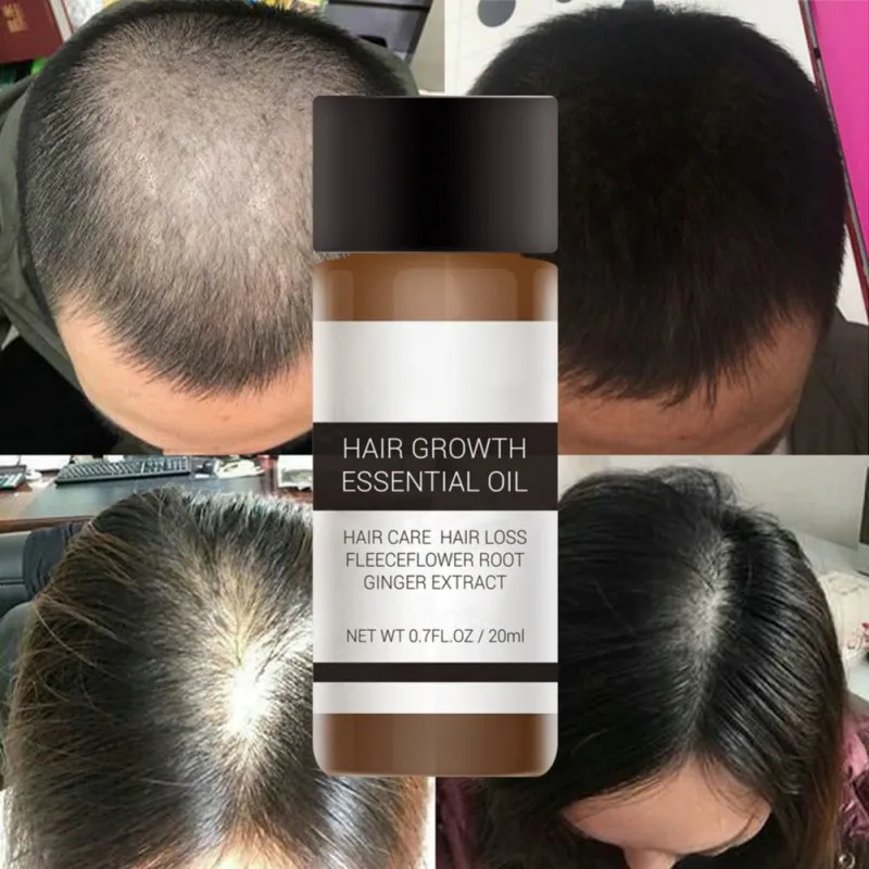 Fast Powerful Hair Growth Essence Products Essential Oil Liquid Treatment Preventing Loss Care 20ml | Красота и здоровье