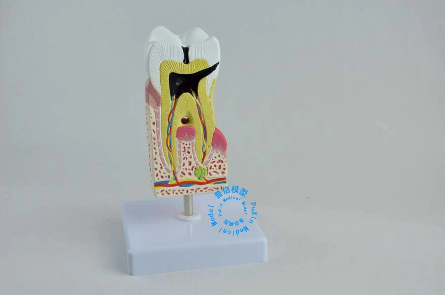 

Free shipping teaching model&Human teeth decayed model amplification anatomic pathological teeth morbid teaching for medical