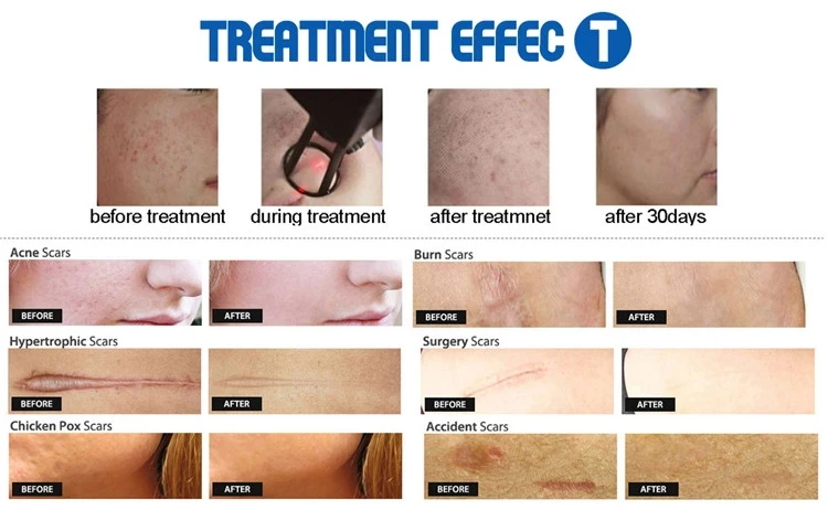 Фракционный Лазер CO2 для укрепления мышц влагалища устранения и морщин