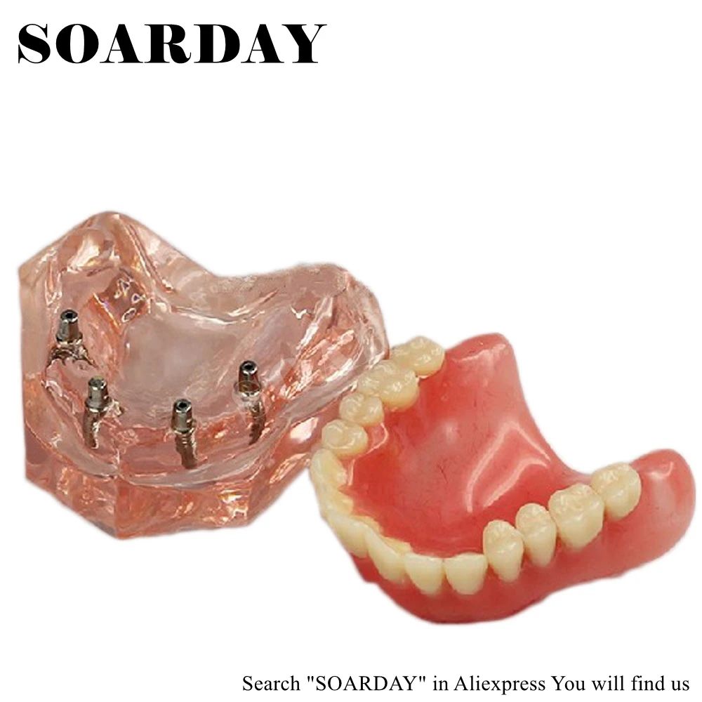 

SOARDAY Overdenture inferior with 4 implants dental for teaching tooth teeth dentist dentistry odontologia
