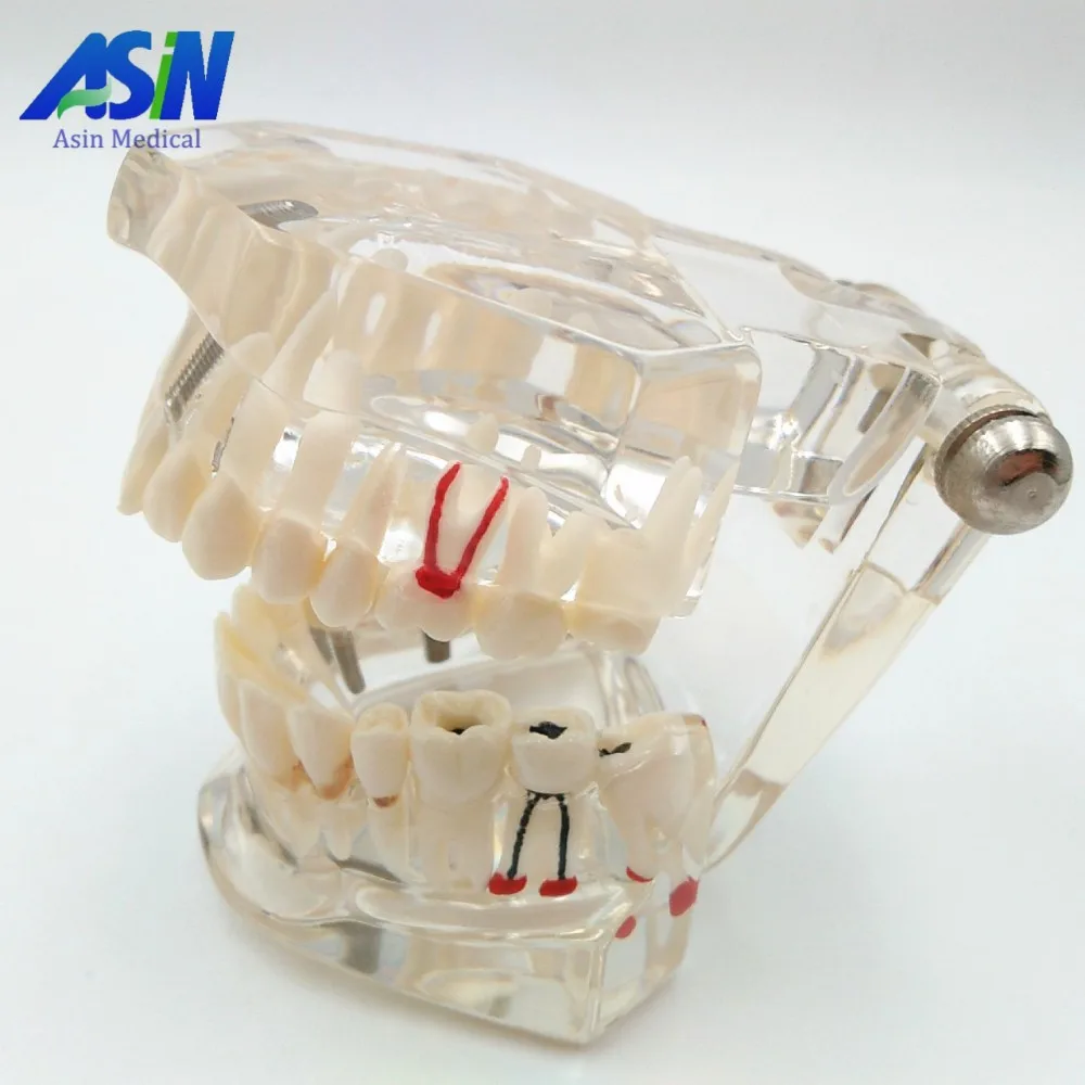 Демонстрационный кронштейн для имплантации зубов модель съемный | Красота и