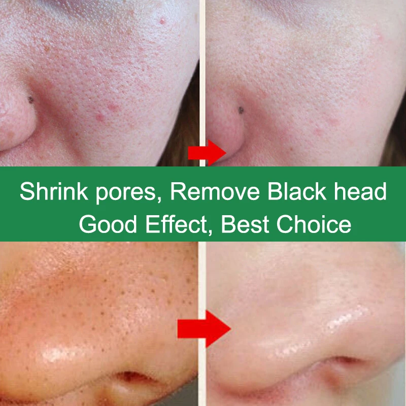 Натуральный растительный экстракт 10 мл средство для удаления черных точек