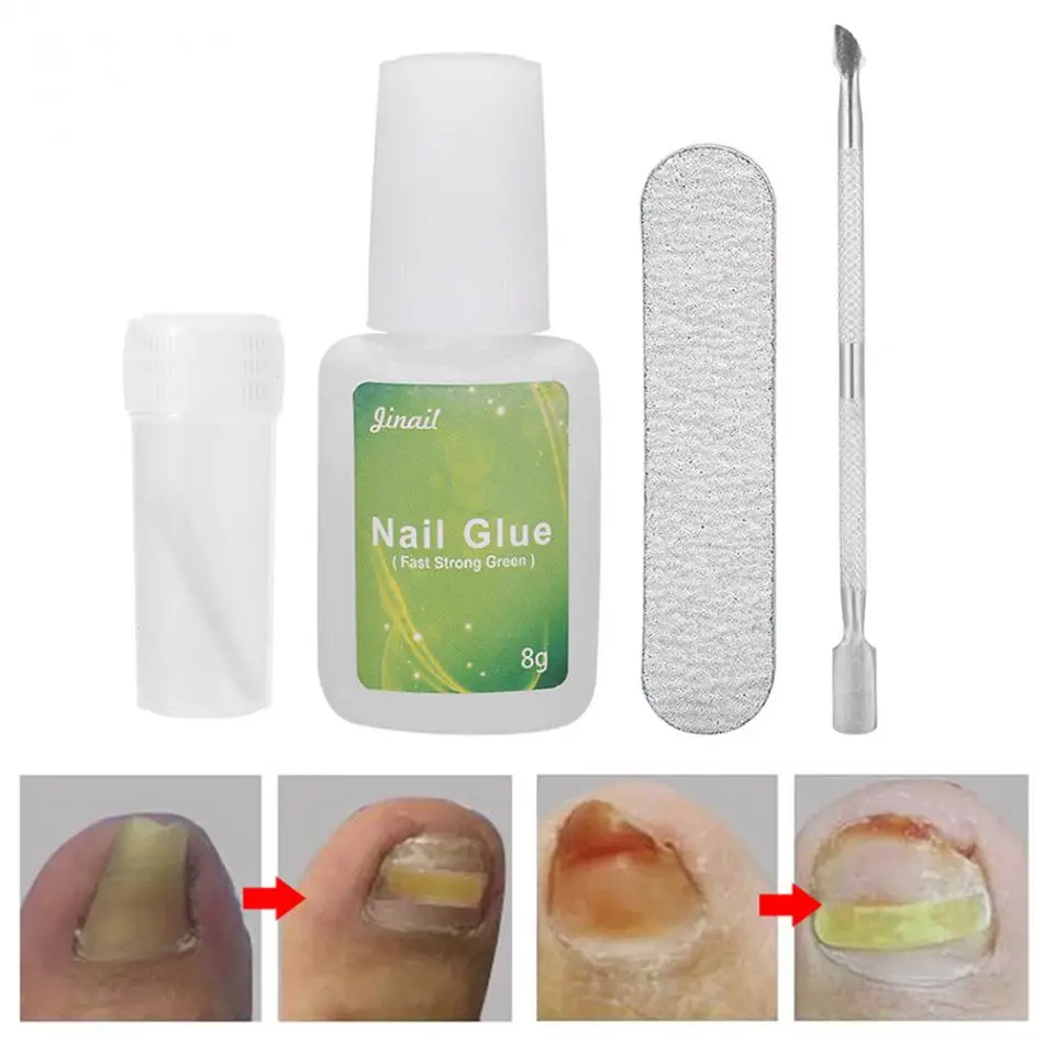 5 шт. инструмент для коррекции вросших ног средство восстановления паранихии