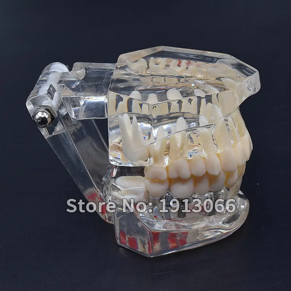 Модель зубного имплантата 1 шт. модель зубных протезов с реставрационным мостом