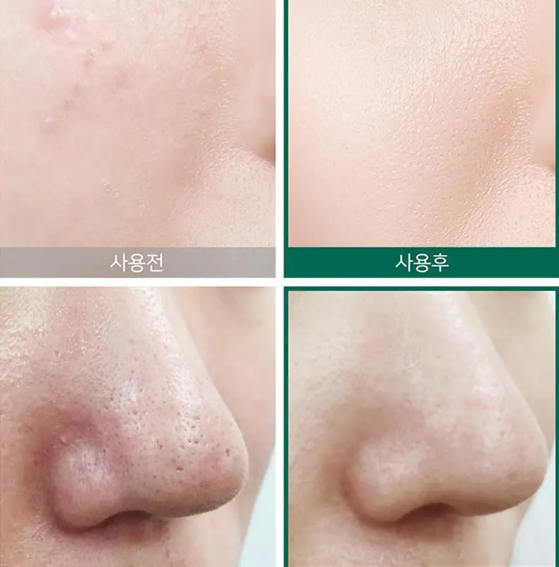 Некоторые MI ана BHA ПГА 30 дней чудо крем + Сыворотки для лица косметический аппарат