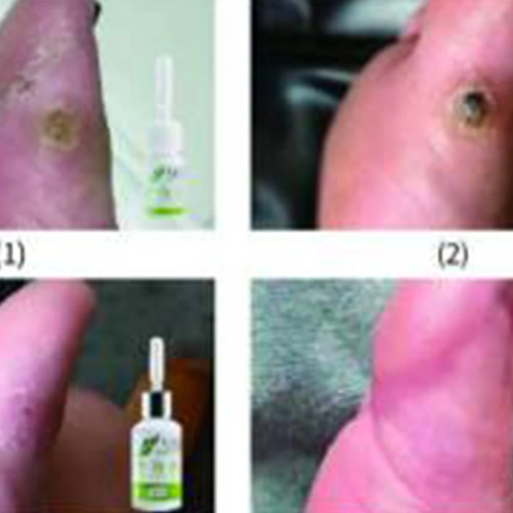 100% профессиональное средство для удаления следов кожи натуральный здоровье моль