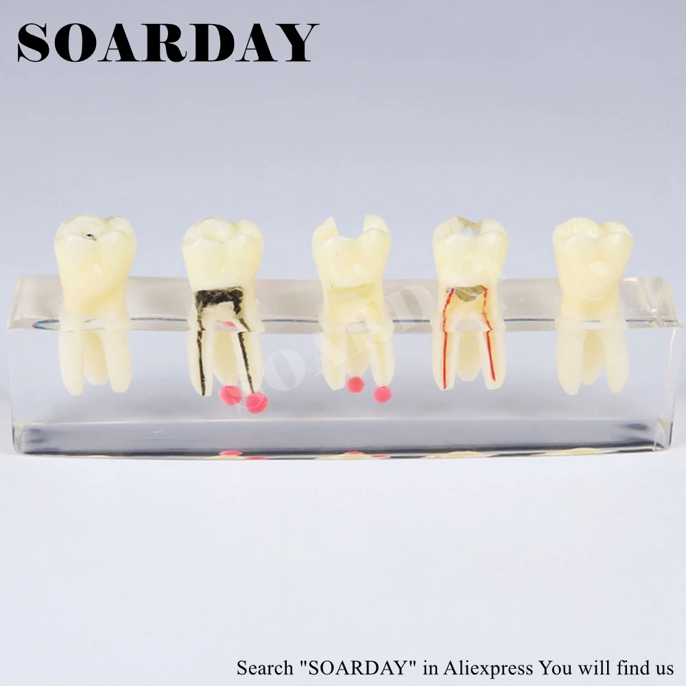 SOARDAY реставрация корневого канала зуба модель оральных стоматологических
