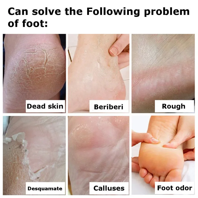 Отшелушивающие кремы для ног Крем треснувшей пятки крем рук против сухой трещины