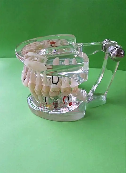

Dental Materials pathology Teeth model Removable free shipping