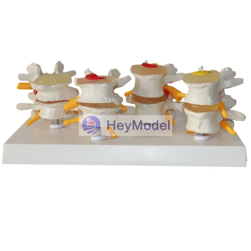 Четырехступенчатая поясничная модель позвоночника HeyModel костные шпоры