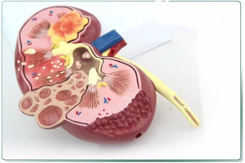 Почечные камни модель болезни Урология почек Nephron почечный гломерулус анатомическая модель почечная анатомическая модель медицинская учебная поставка