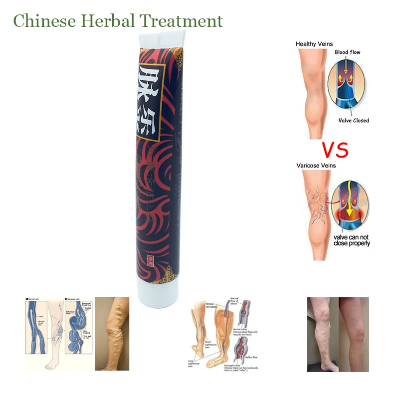100% Оригинальный пластырь для лечения варикозного расширения вен лечение клеток