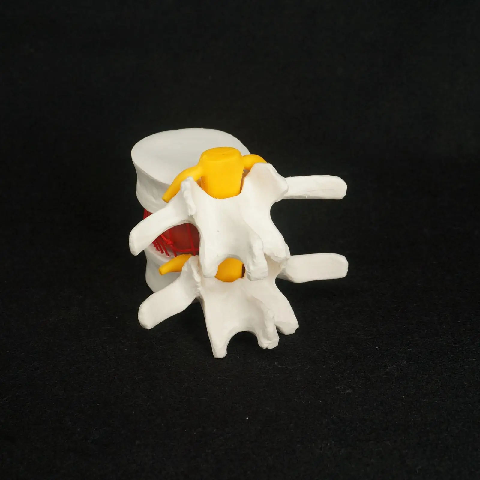 Анатомическая грыжа поясничных позвонков диск пролапс модель человека