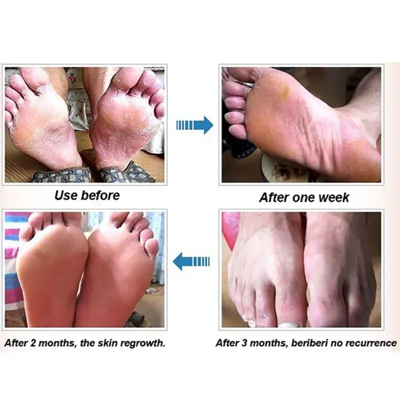 Новое поступление 2019 китайские кремы при псориазе дерматите и экземе зуде