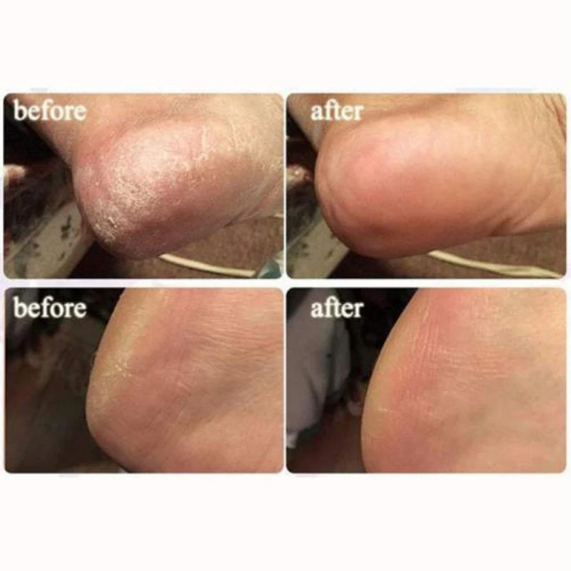 Таблетки для ухода за ногами Ginger Soak шипучие таблетки предотвращение устранения