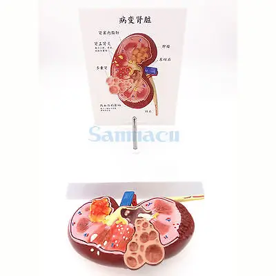 Модель болезненной почки человеческий анатомический медицинский образец