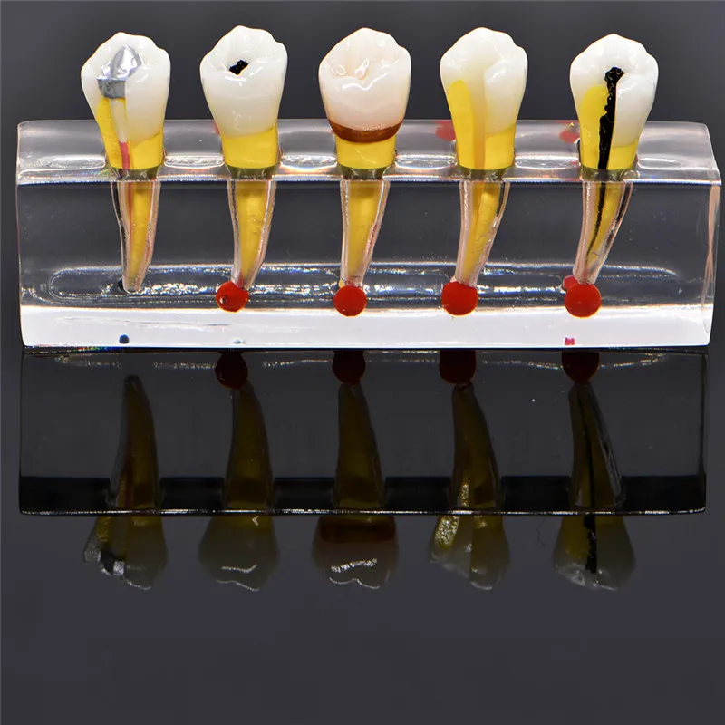 Dental Pulp Restoration Pathological Model with Detachable teeth Premolar caries crown pulp cavity filling | Красота и здоровье