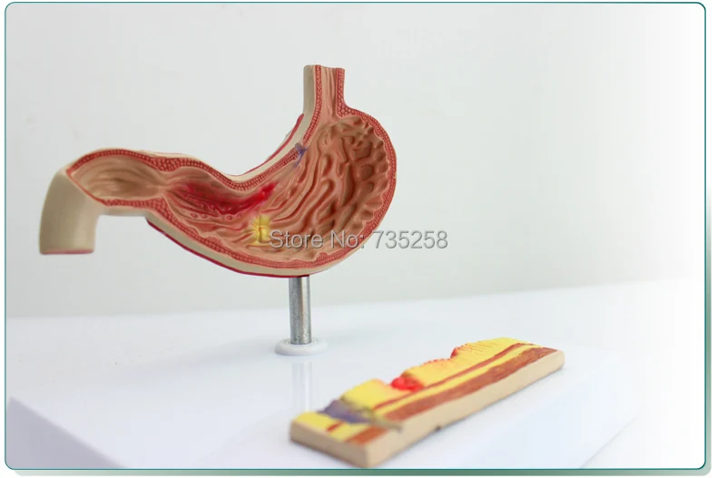 Stomach Trouble Model,Gastritis Display Model,Gastric Ulcer Model,Gastric Anatomy Model