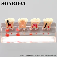 SOARDAY стоматологический эндододонтическая модель для