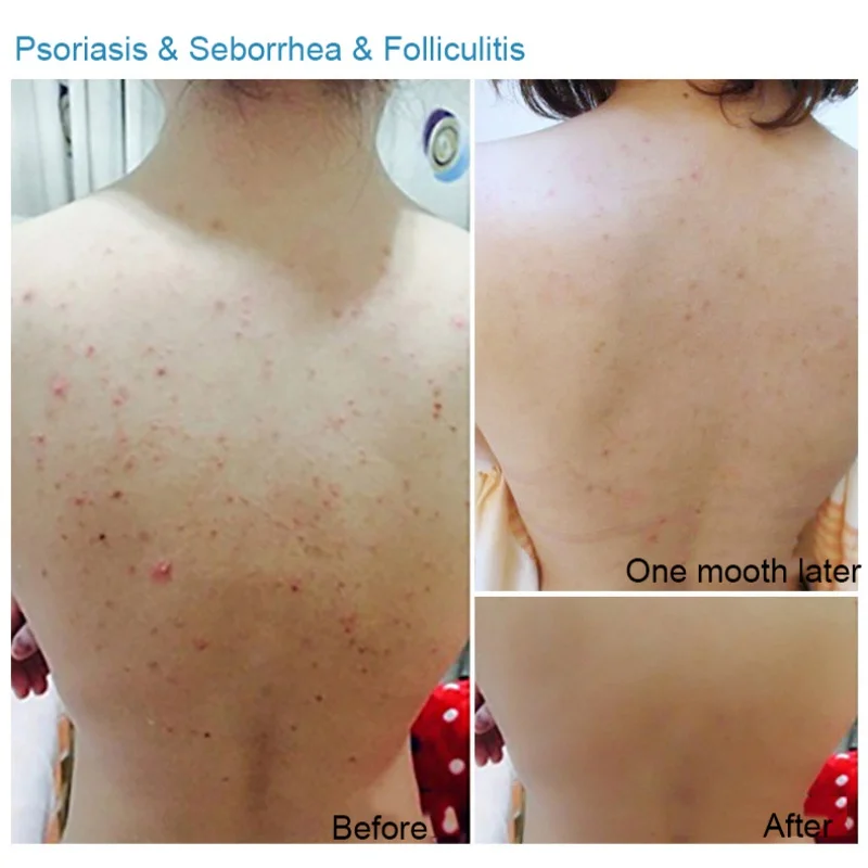 Бамбуковый уголь морская соль лечение акне мыло ручной работы контроль жирности