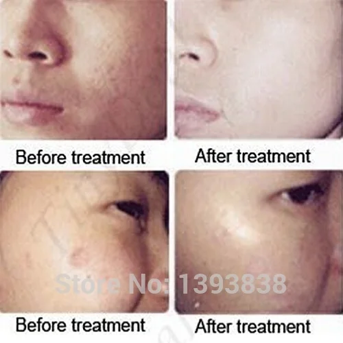 Aloe Acne Vulgaris Scar Whelk Pimple Treatment Remove Vanishing Dispelling Plaster Facial Cream Skin Care
