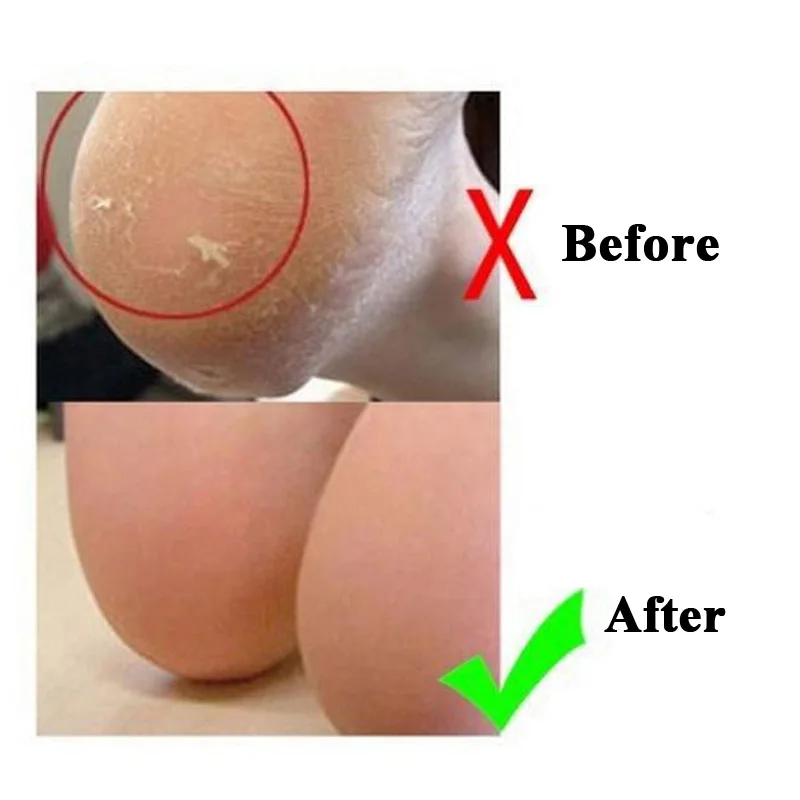 1 пара силиконовые носки для педикюра с подушками|feet care|silicone gel feetheel cushion socks |